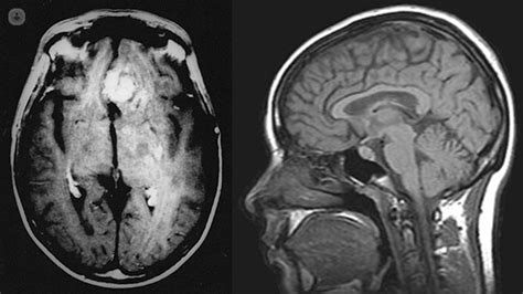 ¿Cuántos tipos de tumores cerebrales hay? | Confirmado