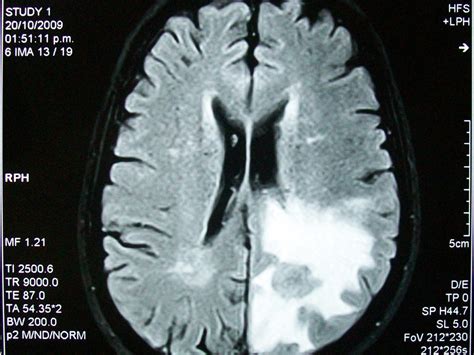 ¿Cuántos tipos de tumores cerebrales hay?