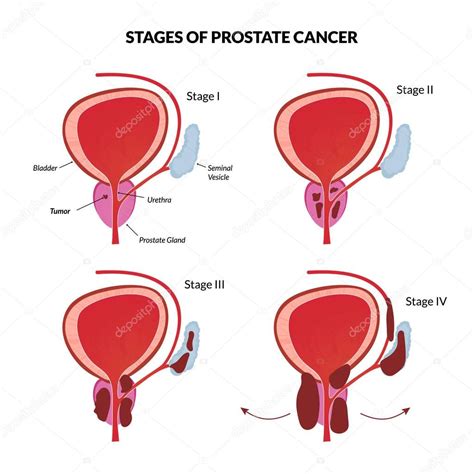 Cuatro etapas del cáncer de próstata 2022