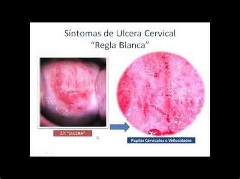 CUELLO DE UTERO   ULCERA   Cervical Cancer   YouTube