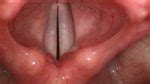 Cuerdas vocales inflamadas o la inflamación de las cuerdas ...