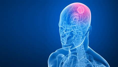 Cuidado con los tumores cerebrales | VIDA | PERU21