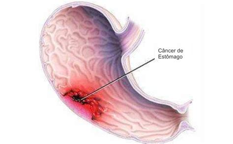 Cura do câncer de estômago depende do diagnóstico precoce
