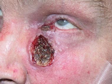 Cutaneous Squamous Cell Carcinoma Clinical Presentation ...