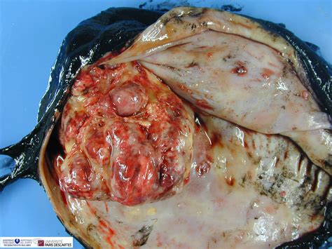 cystic malignant rhabdoid tumor   Humpath.com   Human ...