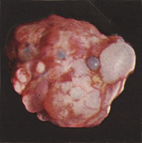 Cystic Teratomas and Teratoid Tumors of the Central Nervous System in ...