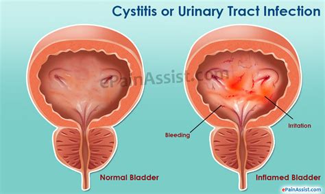 Cystitis or Urinary Tract Infection UTI |Symptoms ...