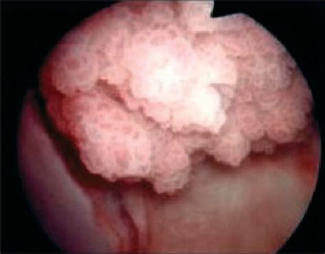 Cystoscopic image of polypoid urinary bladder tumor. Image ...