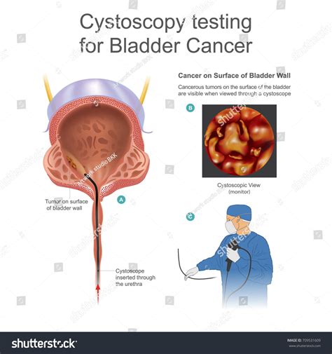 Cystoscopy Testing Bladder Cancer bladder Cancer Any Stock ...