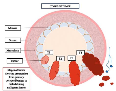 d: The  T  stages of Colorectal cancer starting from T1 ...