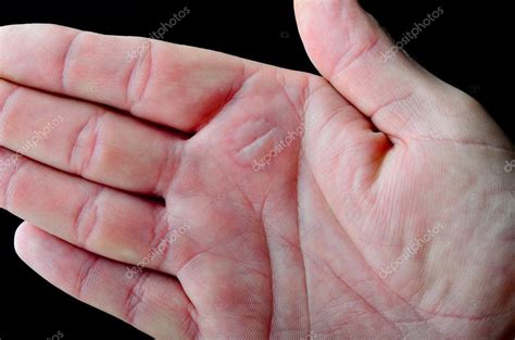 Da bolha na mão, causada por uma queimadura — Stock Photo ...