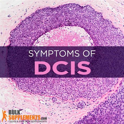 DCIS Ductal Carcinoma in Situ : Symptoms, Causes & Treatment