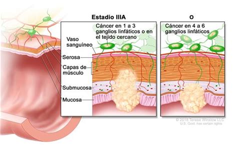 Definición de cáncer colorrectal en estadio IIIA ...