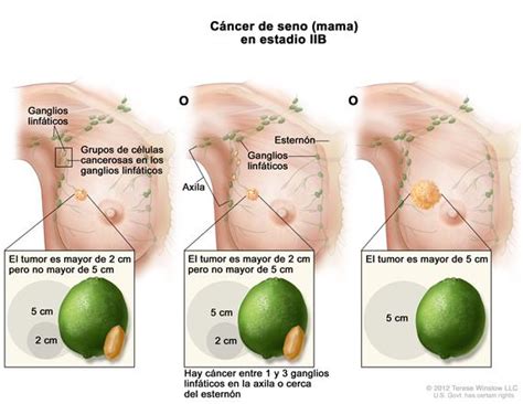 Definición de cáncer de mama en estadio IIB   Diccionario ...