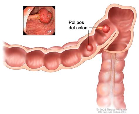 Definición de pólipo del colon   Diccionario de cáncer ...