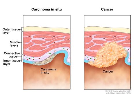 Definition of carcinoma in situ   NCI Dictionary of Cancer ...