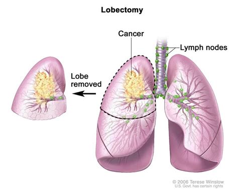 Definition of lobectomy   NCI Dictionary of Cancer Terms ...