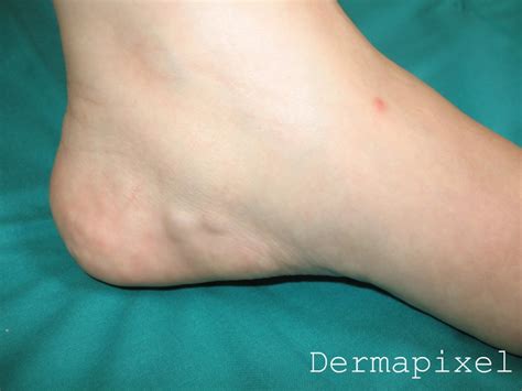 Dermapixel: La niña con bultos en los pies