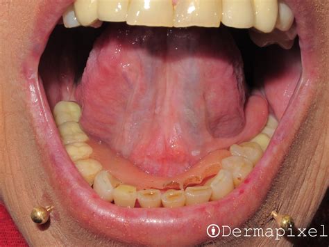 Dermapixel: Leucoplasia: algo más que una manchita en la boca