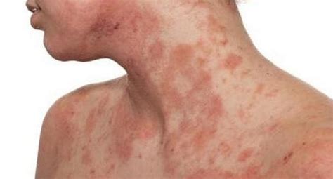 Dermatitis atópica: la enfermedad de la piel que genera depresión y ...