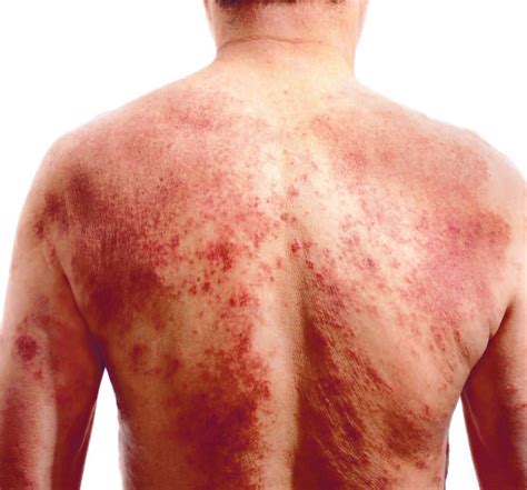Dermatitis atópica, reflejo de las emociones en la piel