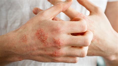 Dermatitis atópica, un problema de salud que afecta más allá de la piel ...