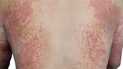 Dermatitis atópica, un problema de salud que afecta más allá de la piel ...