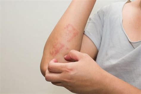 Dermatitis atópica: una enfermedad inflamatoria frecuente de la piel ...