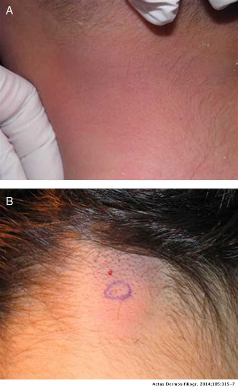 Dermatomiofibroma en la nuca: descripción de 2 casos en la ...