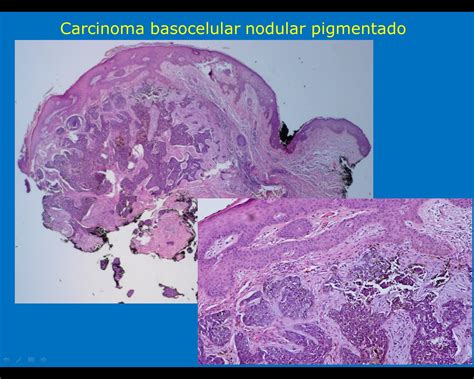 Dermatopatologia: CARCINOMA BASOCELULAR