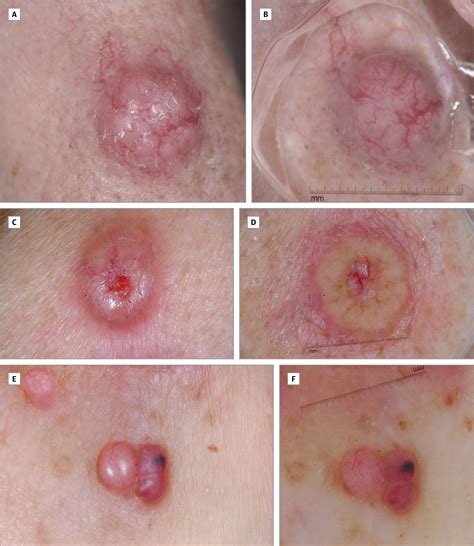 Dermoscopic Findings in Cutaneous Metastases | Breast ...
