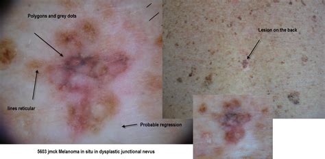 Dermoscopy Made Simple: Melanoma in situ mainly