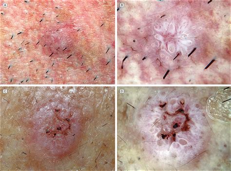 Dermoscopy of Squamous Cell Carcinoma and Keratoacanthoma ...