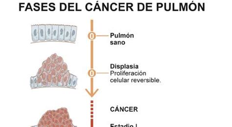 Desarrollo del cáncer de pulmón. Infográfico. Clínica ...