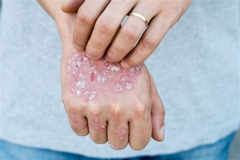 Descubre las 9 enfermedades más comunes en la piel | El Diario NY