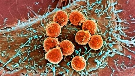 Descubren linfocitos que permiten reducir el tamaño de tumores ...