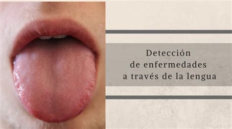Detección de enfermedades a través de la lengua . Blog MQM
