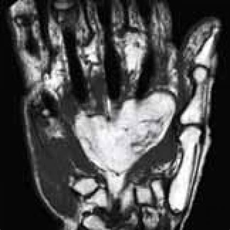 Detección precoz, clave para la remisión de la artritis – Salud y Medicina