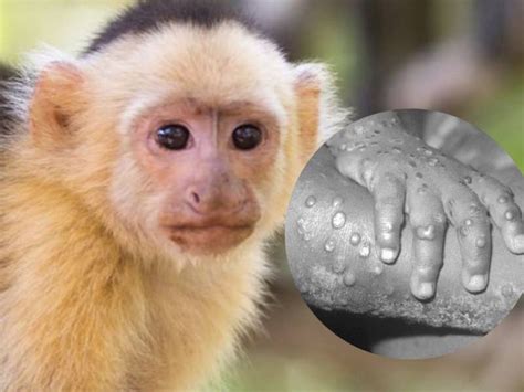 Detectan primer caso de Viruela de Mono que es y como se transmite ...