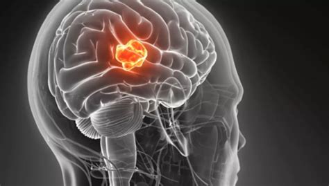 Detectando tumores cerebrales   Gamma Knife