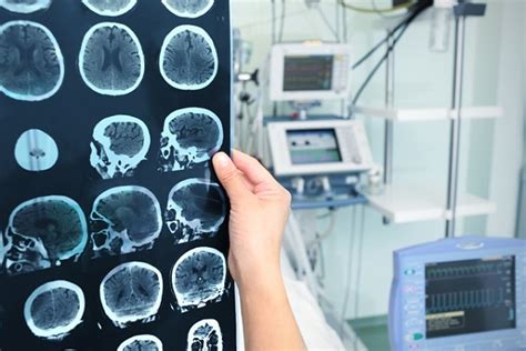 Detectar a tiempo los tumores cerebrales garantiza un mejor pronóstico ...