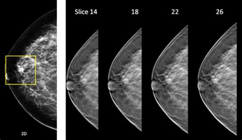 Detecting breast cancer: 3 D screening reduces recall ...