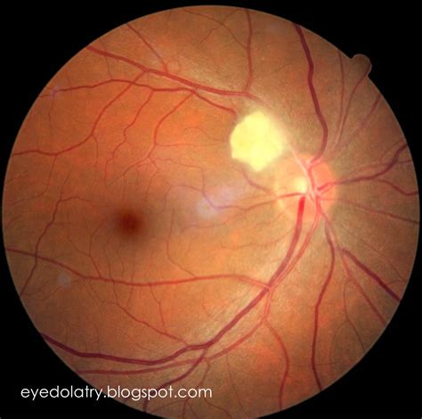 Diagnose My Retinal Photograph: Retinal Hamartoma   Eyedolatry