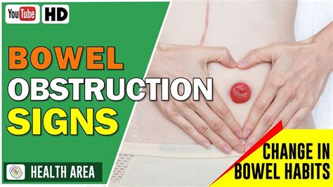 Diagnosing and Treating Bowel Obstruction   Bowel Cancer ...