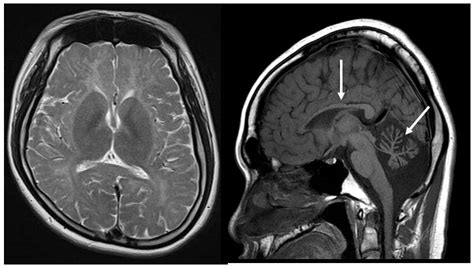 Diagnostic imaging of congenital cerebral hypomyelination ...