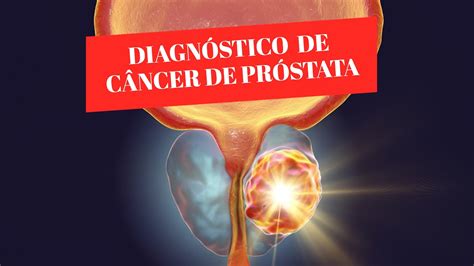 Diagnóstico Câncer de Próstata   YouTube