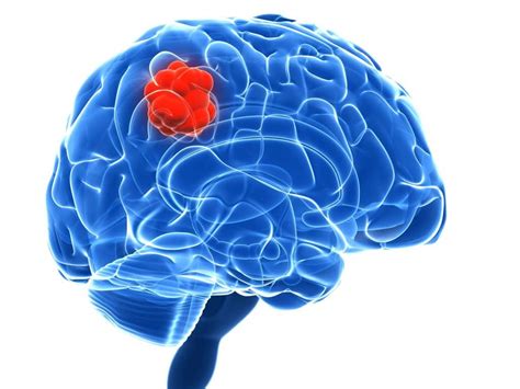 Diagnóstico del tumor cerebral: Todo lo que debes saber