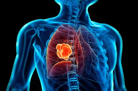 Diagnóstico e tratamento de câncer de pulmão