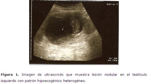 Diagnóstico ecográfico de seminoma testicular. Presentación de un caso ...