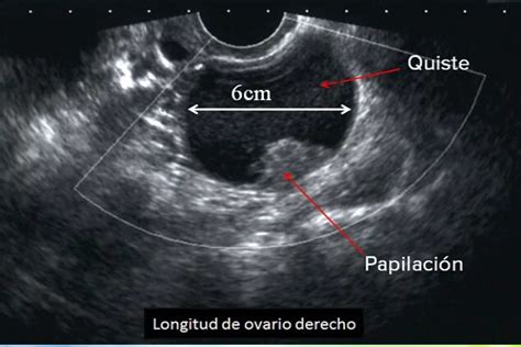 Diagnóstico imagenológico de un teratoma gigante de ovario